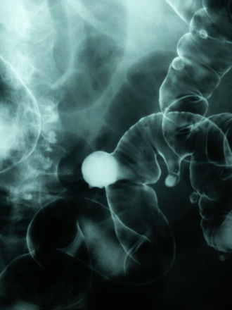 leaky gut syndrome vegamedica