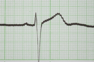 Kr&oacute;tkotrwałe stosowanie niesterydowych lek&oacute;w przeciwzapalnych a ryzyko zgonu i zawału serca